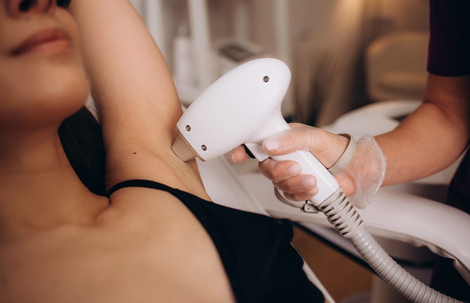 Laser hair removal